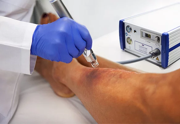 Kaltplasma-Geräte können zur Behandlung chronischer Wunden bei Diabetikern eingesetzt werden.