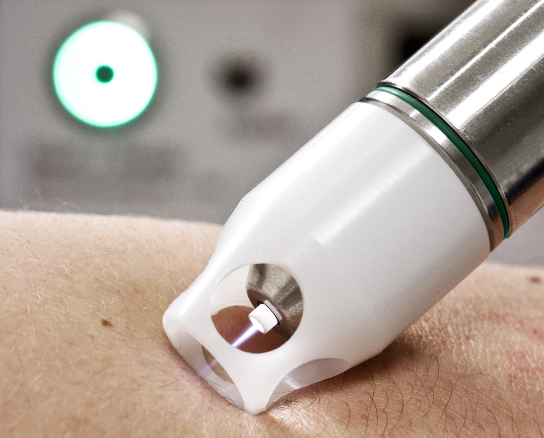 Plasmatherapie mit dem kINPen MED (Foto: neoplas tools GmbH)